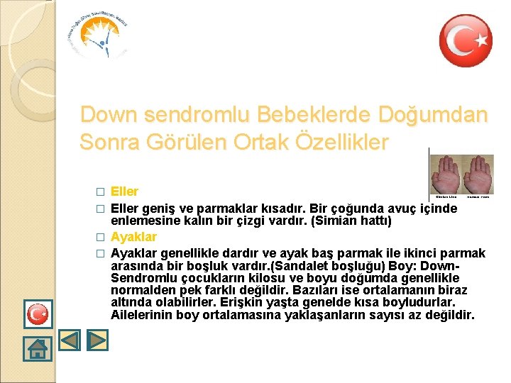 Down sendromlu Bebeklerde Doğumdan Sonra Görülen Ortak Özellikler Eller � Eller geniş ve parmaklar