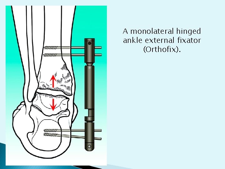 A monolateral hinged ankle external fixator (Orthofix). 