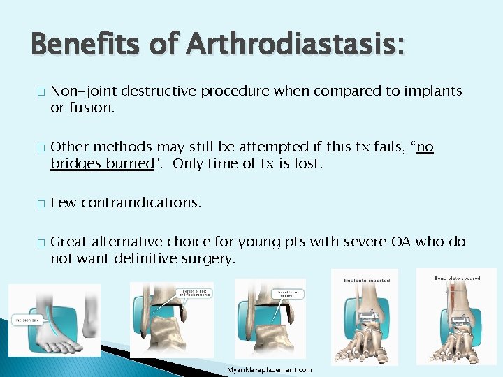 Benefits of Arthrodiastasis: � � Non-joint destructive procedure when compared to implants or fusion.