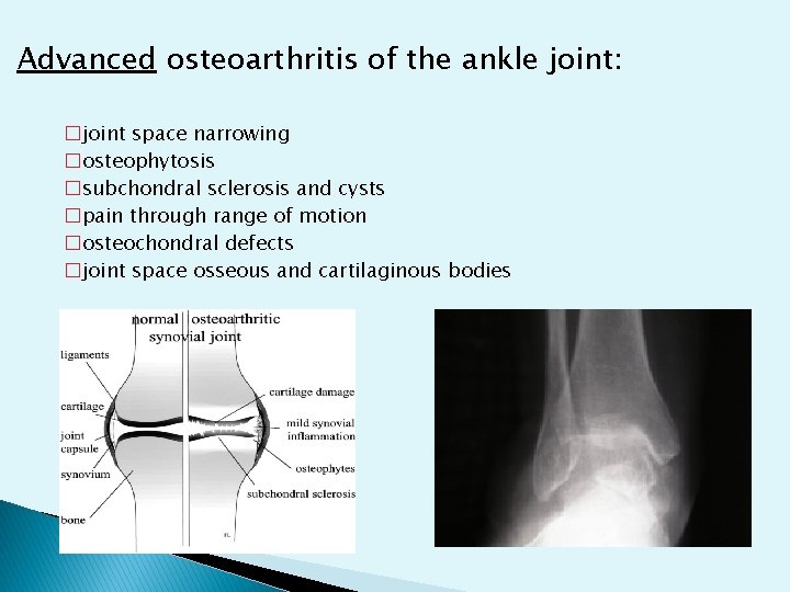 Advanced osteoarthritis of the ankle joint: �joint space narrowing �osteophytosis �subchondral sclerosis and cysts