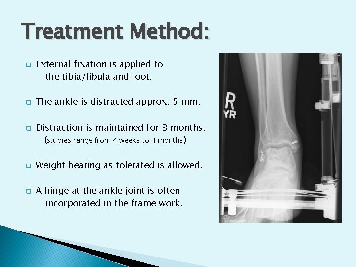 Treatment Method: q q q External fixation is applied to the tibia/fibula and foot.