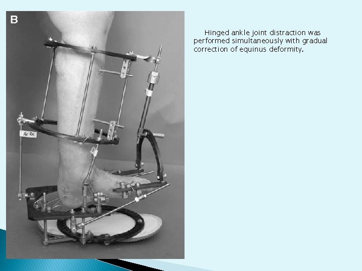 Hinged ankle joint distraction was performed simultaneously with gradual correction of equinus deformity. 