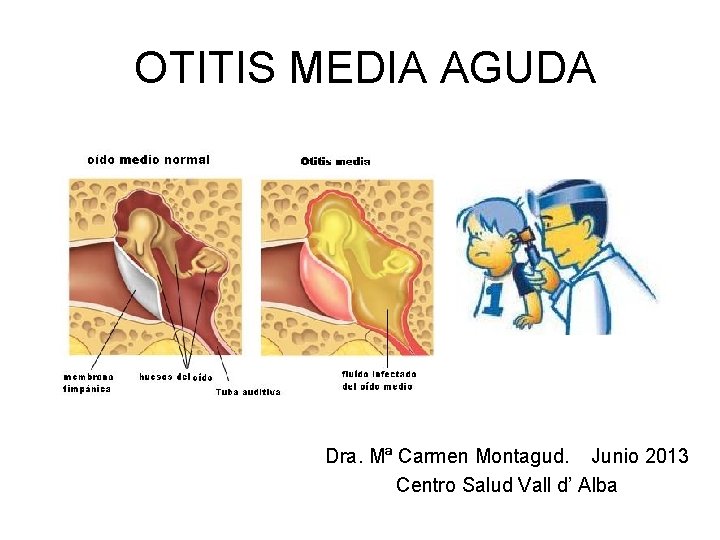 OTITIS MEDIA AGUDA Dra. Mª Carmen Montagud. Junio 2013 Centro Salud Vall d’ Alba