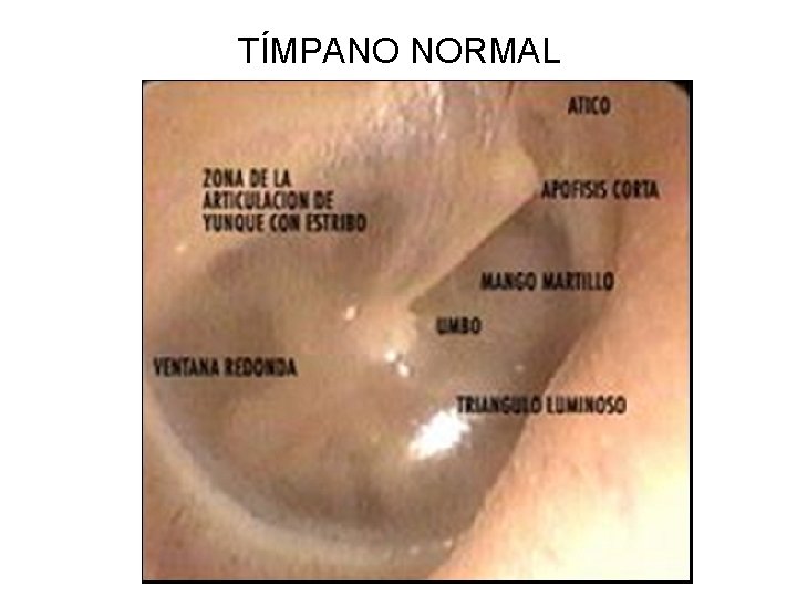 TÍMPANO NORMAL 