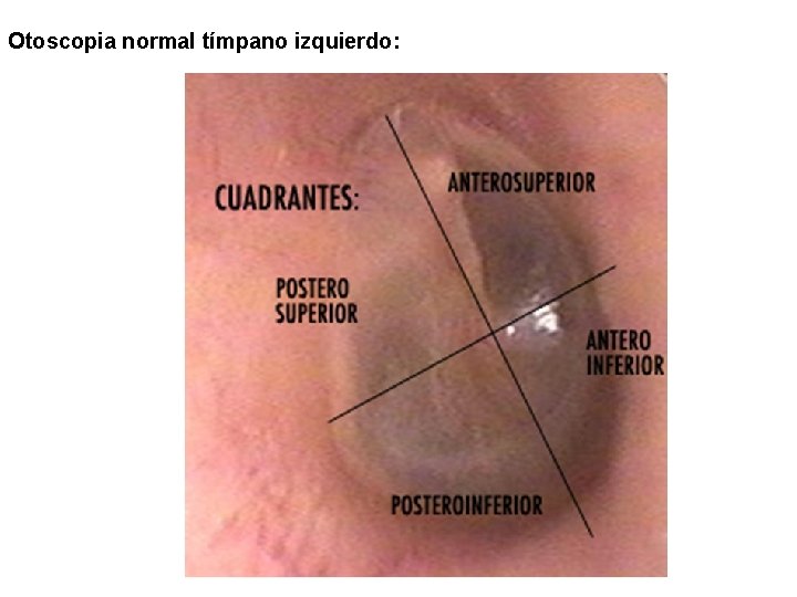 Otoscopia normal tímpano izquierdo: 