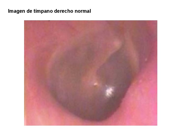 Imagen de tímpano derecho normal 