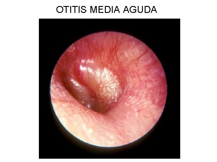 OTITIS MEDIA AGUDA 