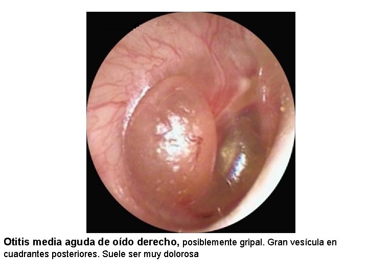 Otitis media aguda de oído derecho, posiblemente gripal. Gran vesícula en cuadrantes posteriores. Suele