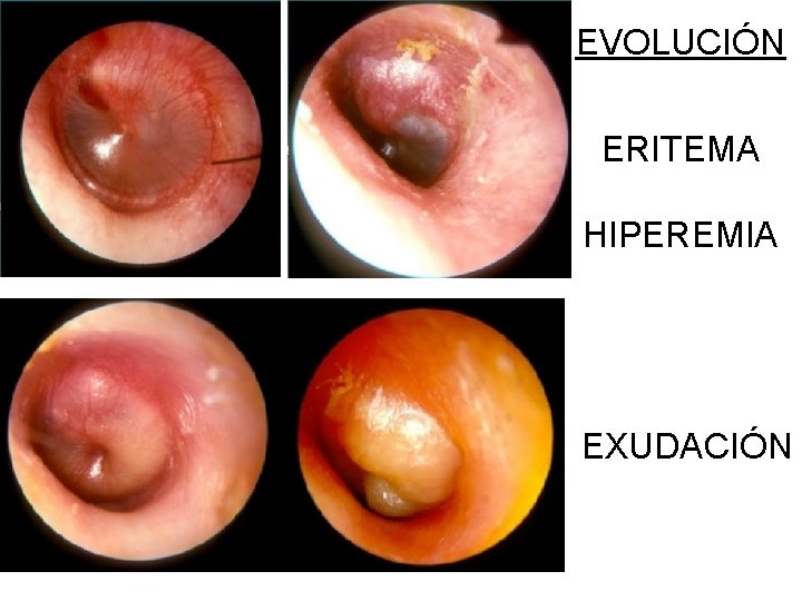 EVOLUCIÓN ERITEMA HIPEREMIA EXUDACIÓN 