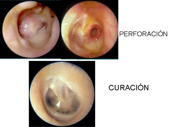 PERFORACIÓN CURACIÓN 