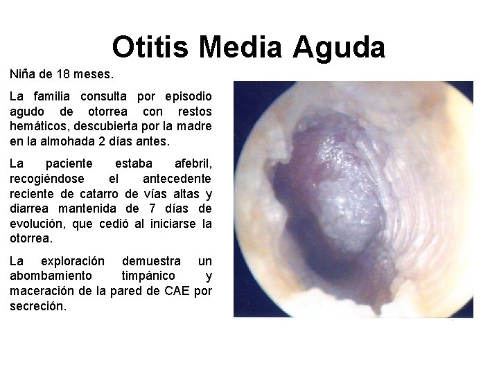 Otitis Media Aguda Niña de 18 meses. La familia consulta por episodio agudo de