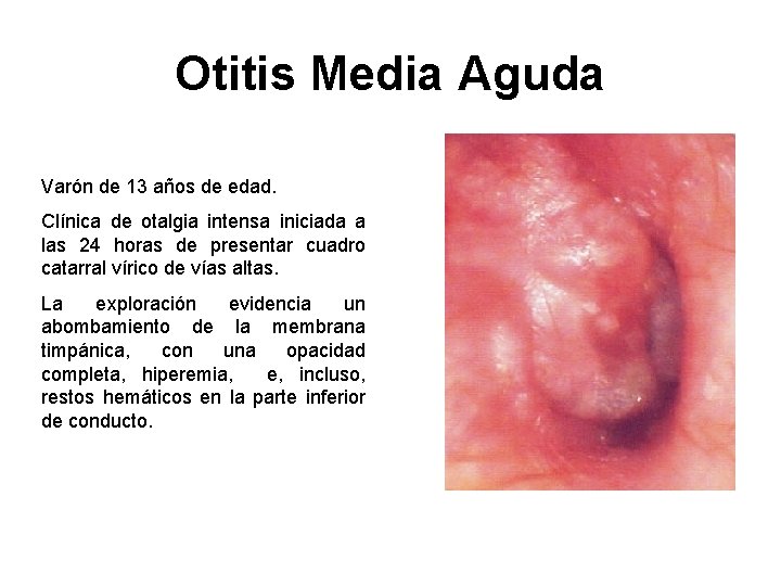 Otitis Media Aguda Varón de 13 años de edad. Clínica de otalgia intensa iniciada