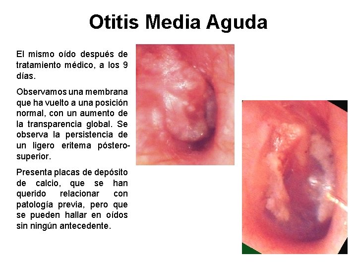 Otitis Media Aguda El mismo oído después de tratamiento médico, a los 9 días.