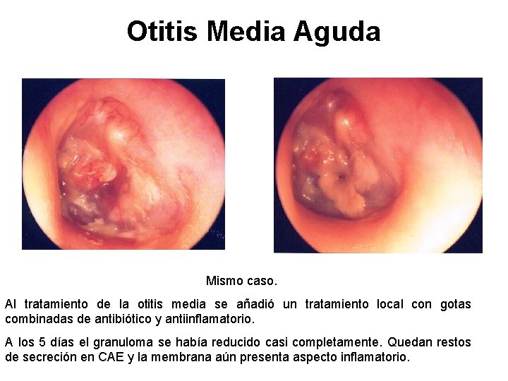 Otitis Media Aguda Mismo caso. Al tratamiento de la otitis media se añadió un