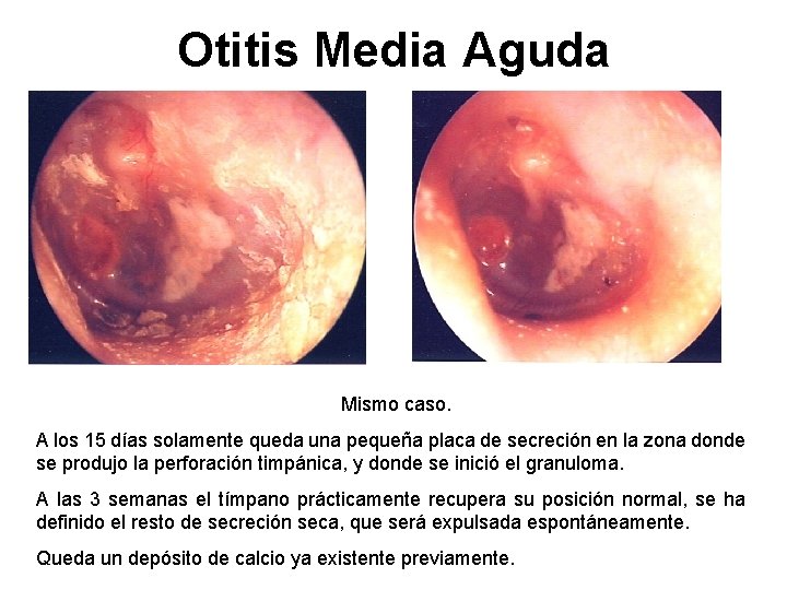 Otitis Media Aguda Mismo caso. A los 15 días solamente queda una pequeña placa