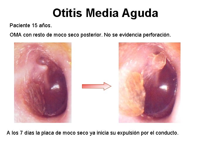 Otitis Media Aguda Paciente 15 años. OMA con resto de moco seco posterior. No