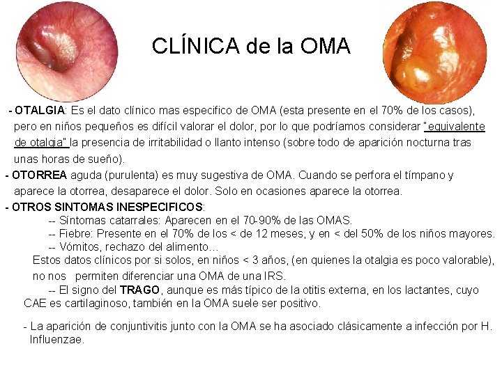 CLÍNICA de la OMA - OTALGIA: Es el dato clínico mas especifico de OMA