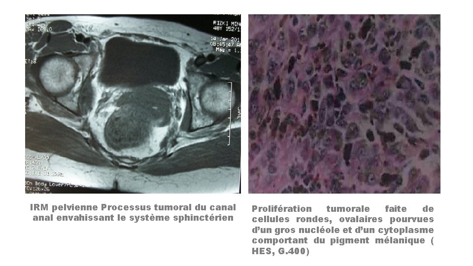 IRM pelvienne Processus tumoral du canal envahissant le système sphinctérien Prolifération tumorale faite de