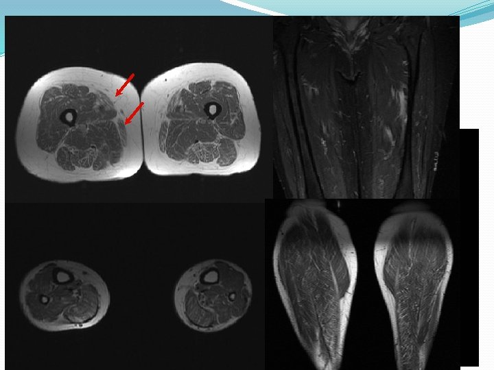 PRUEBAS COMPLEMENTARIAS: Estudios para descartar miastenia (electrofisiológicos y serológicos, anticuerpos): N Hormonas tiroideas: N