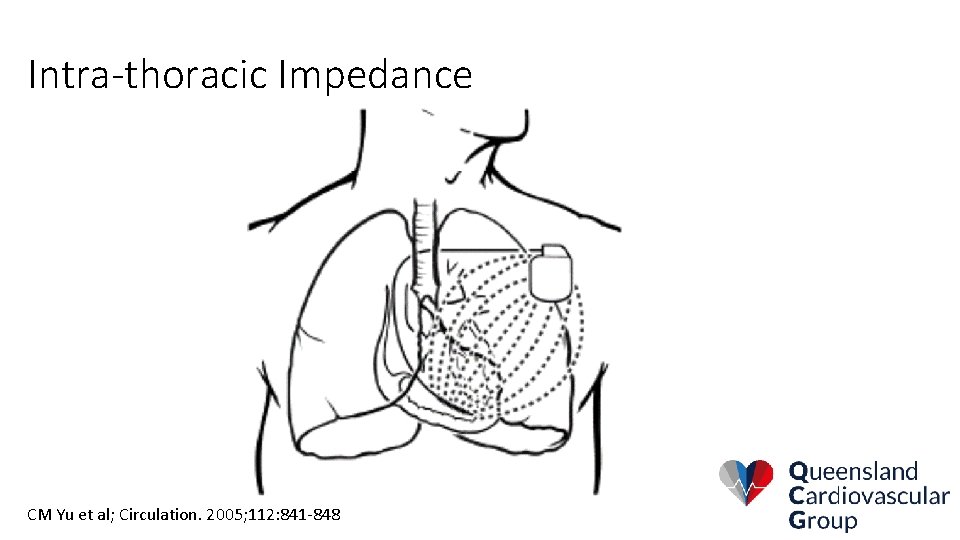 Intra-thoracic Impedance CM Yu et al; Circulation. 2005; 112: 841 -848 