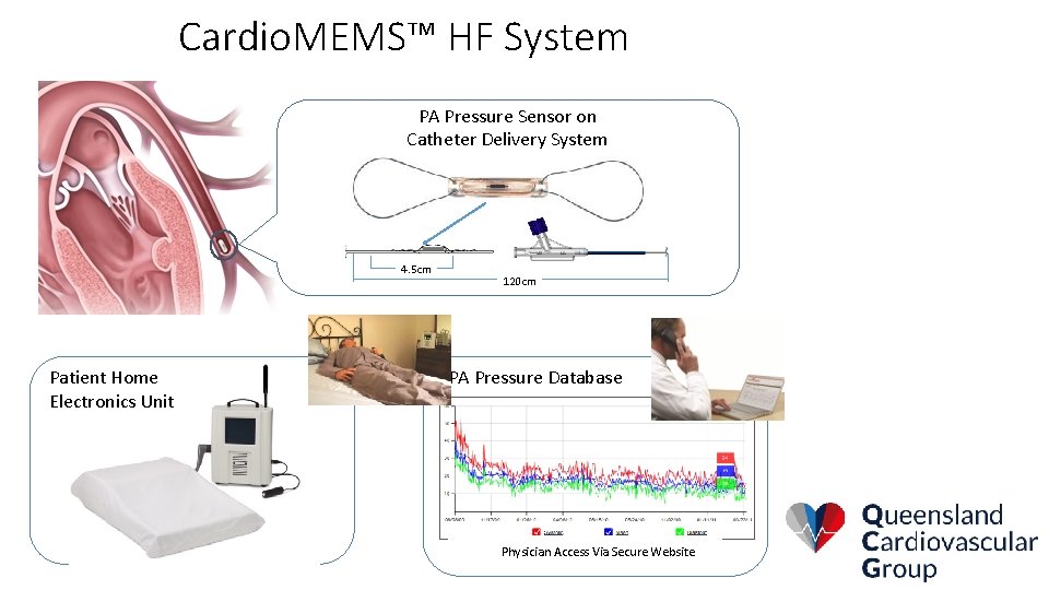 Cardio. MEMS™ HF System PA Pressure Sensor on Catheter Delivery System 4. 5 cm