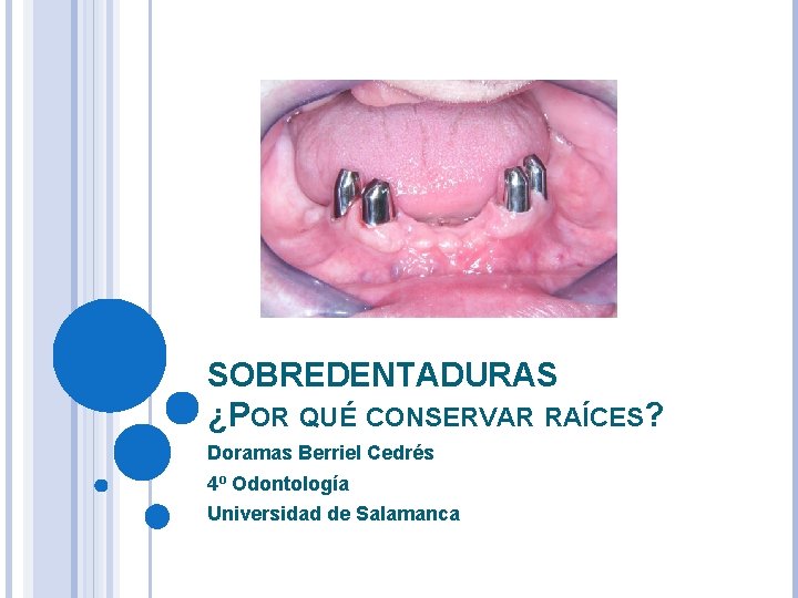 SOBREDENTADURAS ¿POR QUÉ CONSERVAR RAÍCES? Doramas Berriel Cedrés 4º Odontología Universidad de Salamanca 