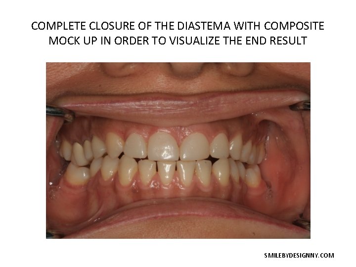 COMPLETE CLOSURE OF THE DIASTEMA WITH COMPOSITE MOCK UP IN ORDER TO VISUALIZE THE