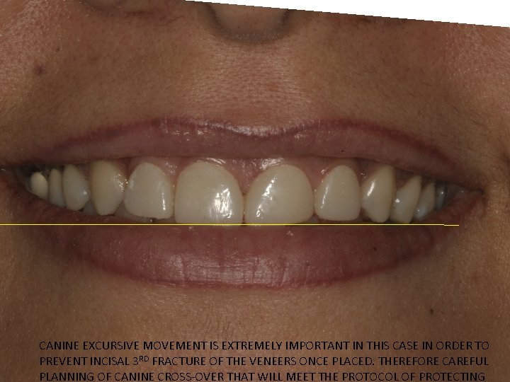 CANINE EXCURSIVE MOVEMENT IS EXTREMELY IMPORTANT IN THIS CASE IN ORDER TO PREVENT INCISAL