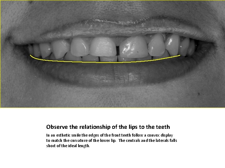 Observe the relationship of the lips to the teeth In an esthetic smile the