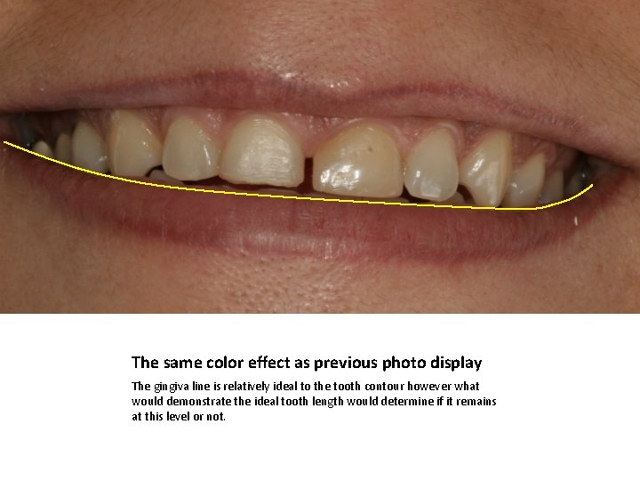 The same color effect as previous photo display The gingiva line is relatively ideal