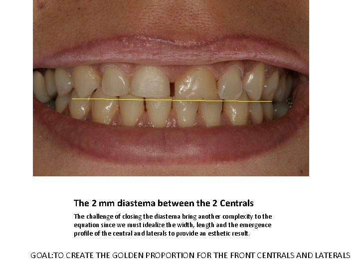 The 2 mm diastema between the 2 Centrals The challenge of closing the diastema