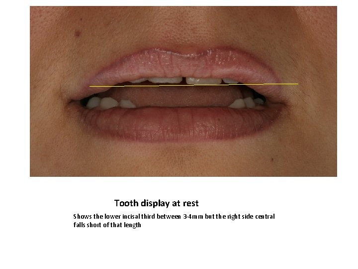 Tooth display at rest Shows the lower incisal third between 3 -4 mm but