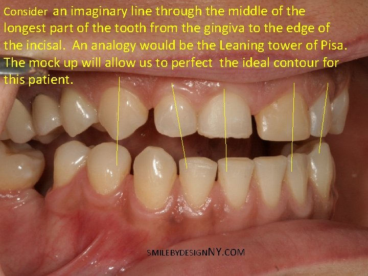 Consider an imaginary line through the middle of the longest part of the tooth