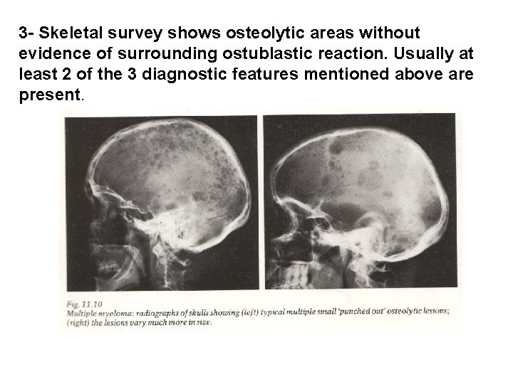 3 - Skeletal survey shows osteolytic areas without evidence of surrounding ostublastic reaction. Usually