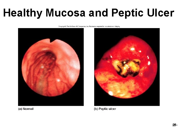 Healthy Mucosa and Peptic Ulcer 25 - 