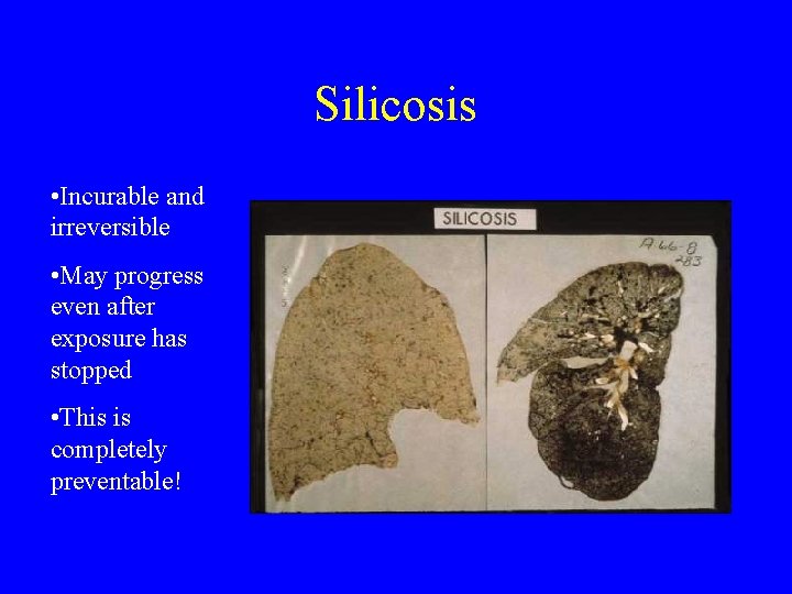 Silicosis • Incurable and irreversible • May progress even after exposure has stopped •