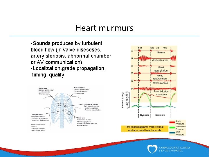 Heart murmurs • Sounds produces by turbulent blood flow (in valve diseseses, artery stenosis,