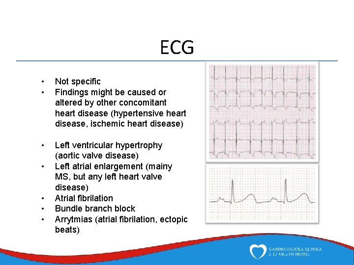 ECG • • Not specific Findings might be caused or altered by other concomitant