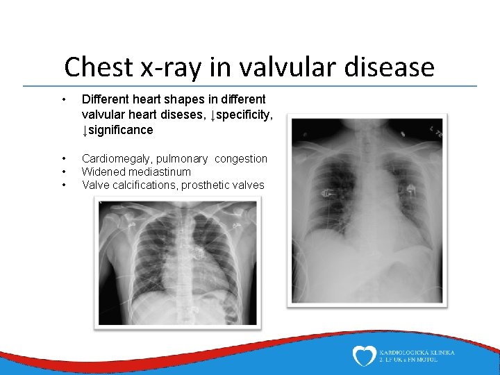 Chest x-ray in valvular disease • Different heart shapes in different valvular heart diseses,