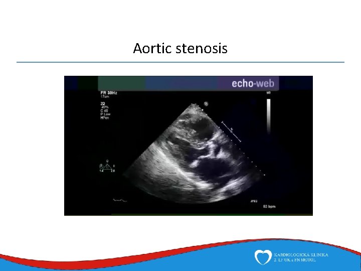 Aortic stenosis 