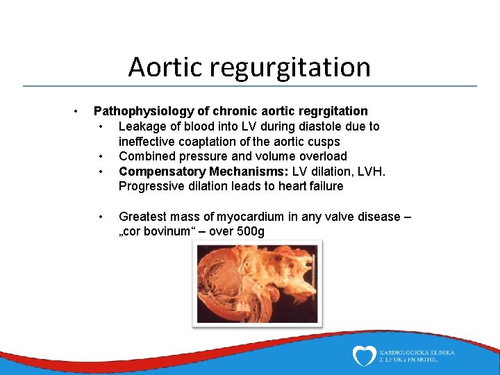 Aortic regurgitation • Pathophysiology of chronic aortic regrgitation • Leakage of blood into LV