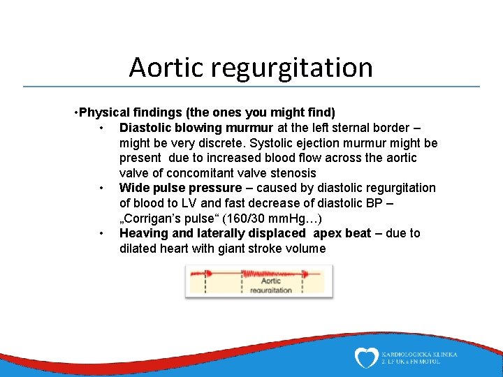 Aortic regurgitation • Physical findings (the ones you might find) • Diastolic blowing murmur