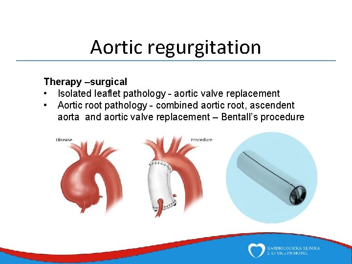 Aortic regurgitation Therapy –surgical • Isolated leaflet pathology - aortic valve replacement • Aortic