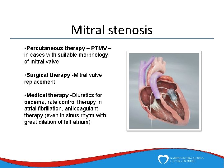 Mitral stenosis • Percutaneous therapy – PTMV – in cases with suitable morphology of