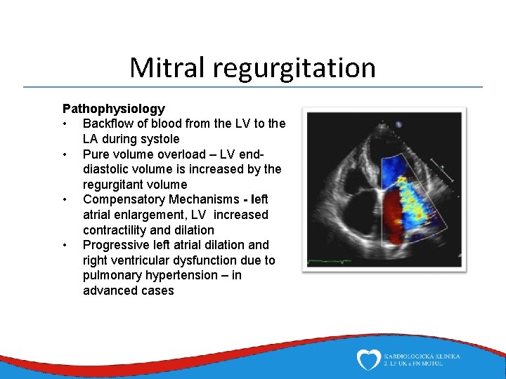 Mitral regurgitation Pathophysiology • Backflow of blood from the LV to the LA during