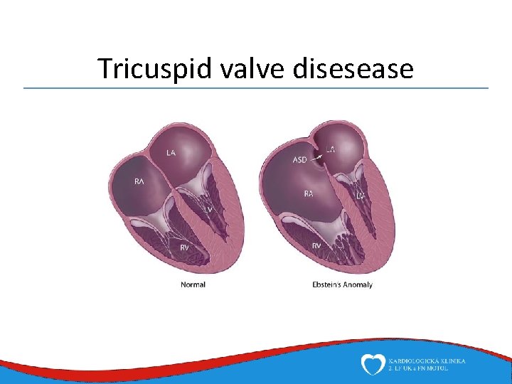 Tricuspid valve disesease 