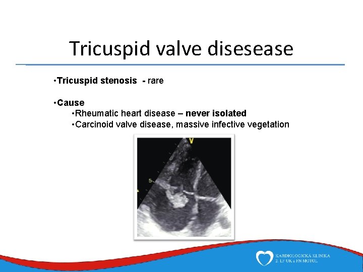 Tricuspid valve disesease • Tricuspid stenosis - rare • Cause • Rheumatic heart disease