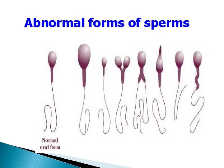Abnormal forms of sperms 