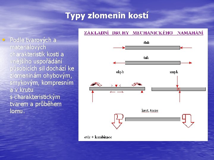 Typy zlomenin kostí • Podle tvarových a materiálových charakteristik kosti a vnějšího uspořádání působících