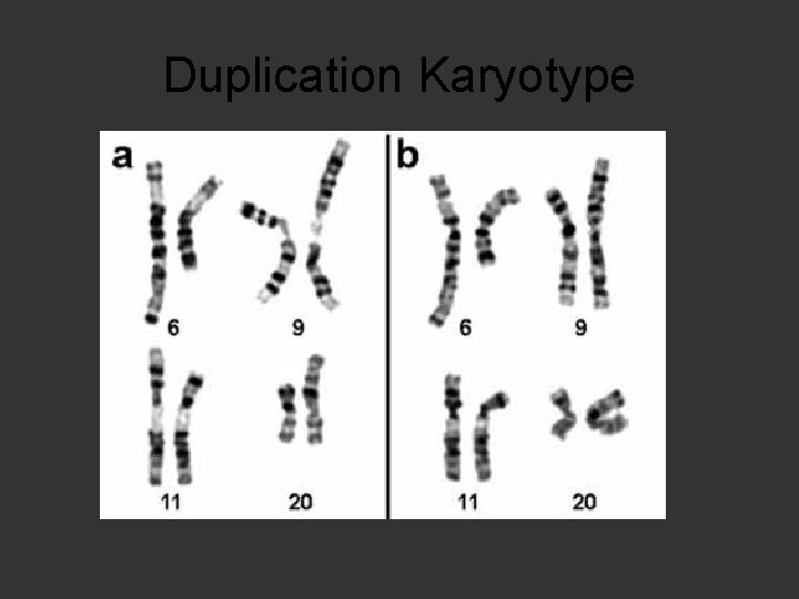Duplication Karyotype 